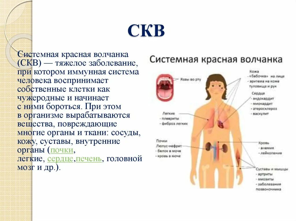 системная волчанка симптомы у женщин. системная красная волчанка диагностика. системная волчанка симптомы у женщин. системная волчанка симптомы у женщин. системная красная волчанка симптомы на коже.