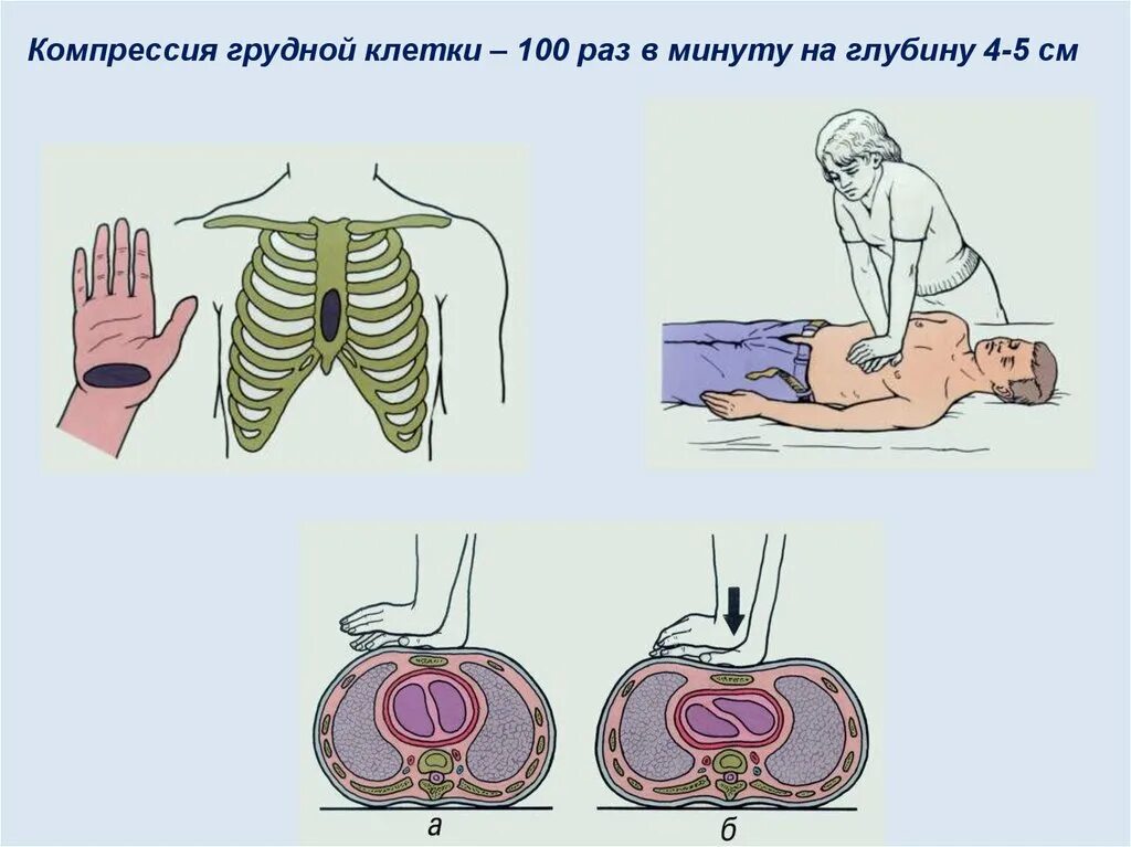 Компрессия грудной клетки. Компрессии грудной Клн. Сдавление грудной клетки. Сдавлениегрудной клетк. Сжатие груди