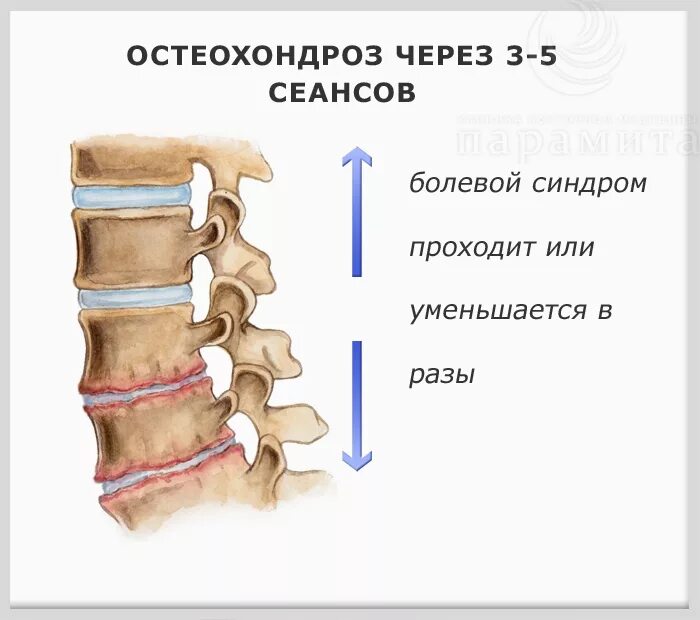 Остеохондроз какие степени