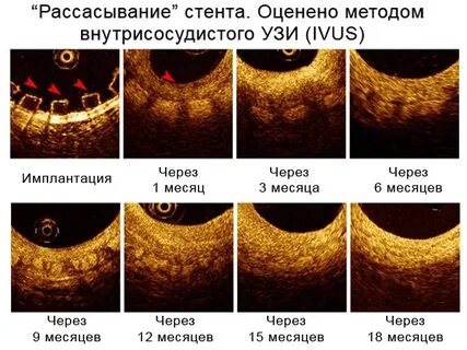 Месяц после стентирования