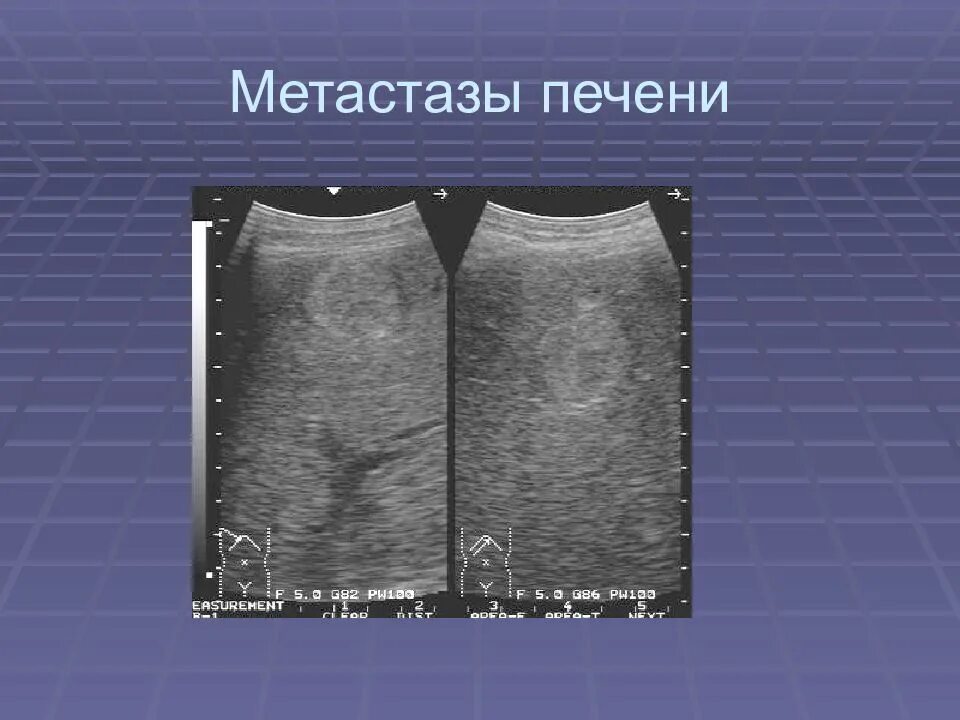 Метастазы в печени на узи. Метастазы в печени на узи