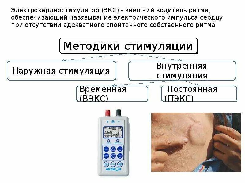 Если стоит кардиостимулятор можно. Внешний кардиостимулятор. Кардиостимулятор прибор. Электрокардиостимулятор наружный. Кардиостимулятор временный наружный.