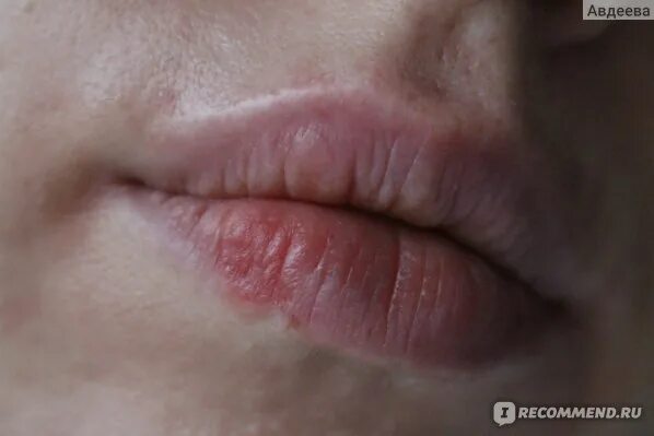 Рак губы признаки фото и лечение Pin by yza drella on moodboards Color, Flickr
