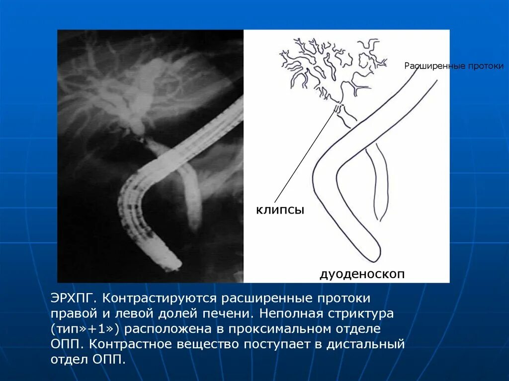 Стеноз проксимального отдела. Стеноз холедоха классификация. дистальный отдел желчного протока.