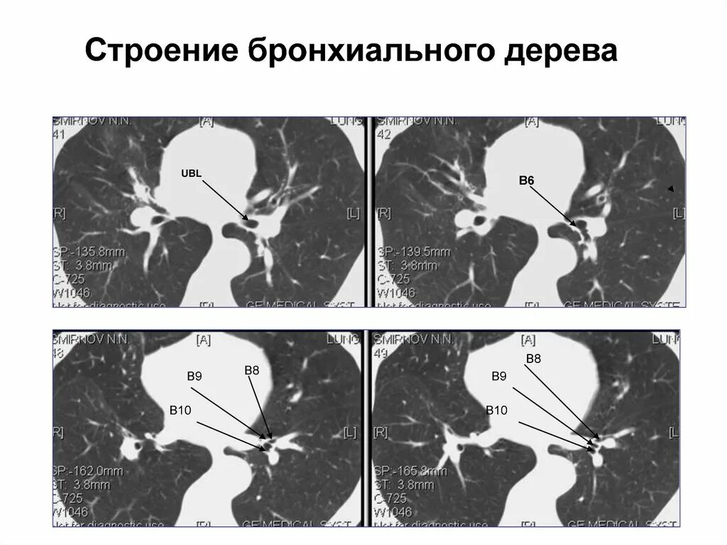 Бронх дерево строение. Деление бронхов на кт. бронхи анатомия кт. строение бронхов на кт. бронхи на кт схема.