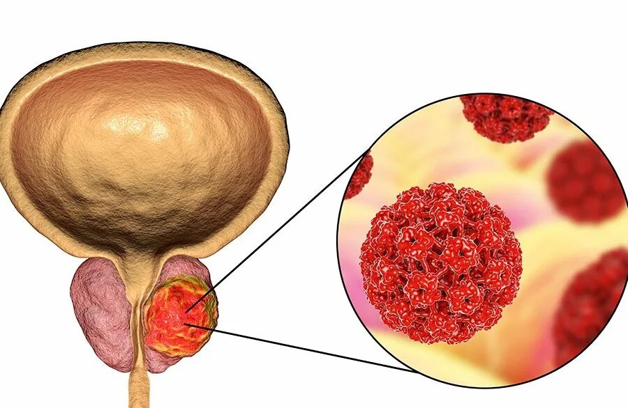 Злокачественная опухоль предстательной железы. Карцинома предстательной железы. Cancer предстательной железы. Парауретральные железы. Первые признаки предстательной железы