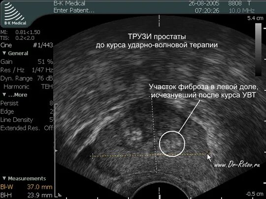 Фиброзные изменения предстательной железы. Хронический калькулезный простатит узи. предстательная железа аденома на узи зоны. кальцинаты в предстательной железе узи. узи доброкачественная гиперплазия предстательной железы.