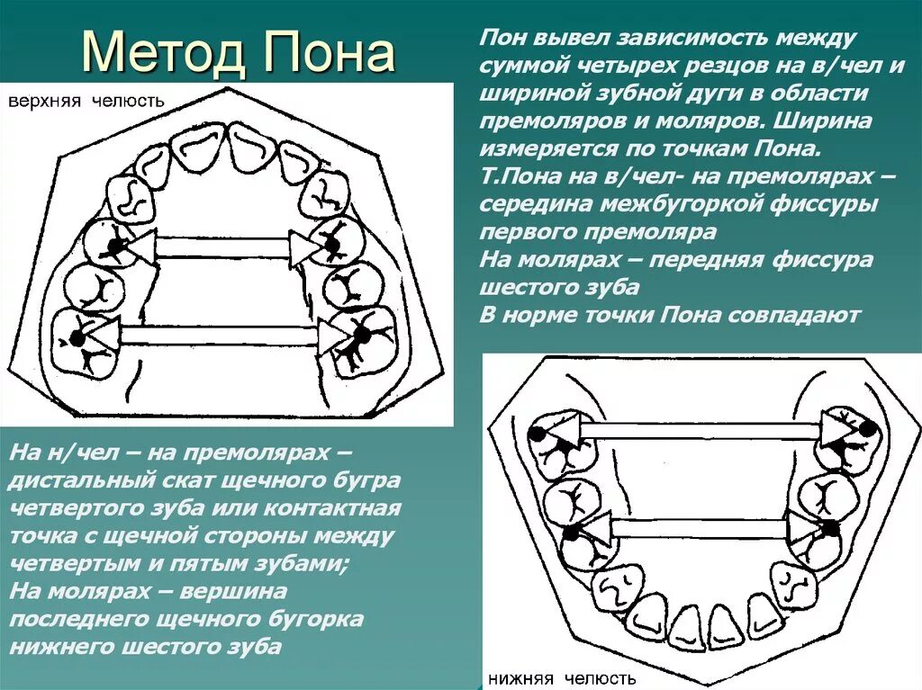 Пону россии. Точки пона на верхней челюсти. Метод пона ортодонтия таблица. Метод корхаруса ортрдонтия. Ширина зубной дуги в области премоляров.