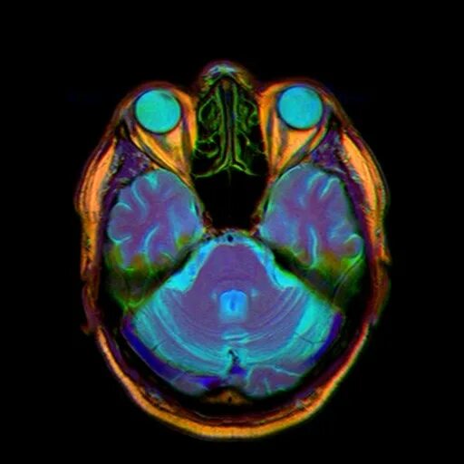 Мрт глазных орбит. Мрт глазных орбит и зрительных нервов. T2w FFE мрт. T2w TSE мрт.