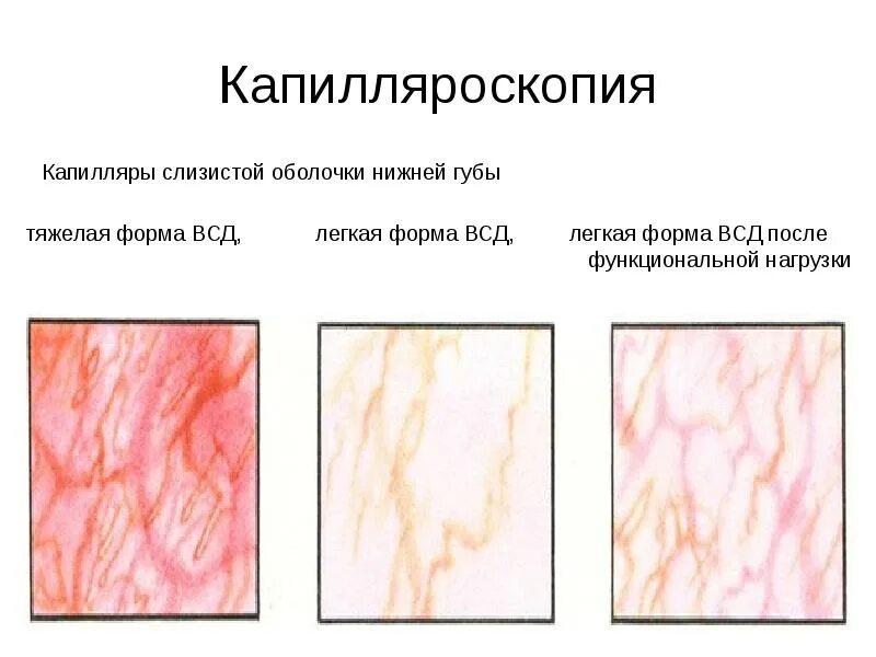 Заполнения капилляров