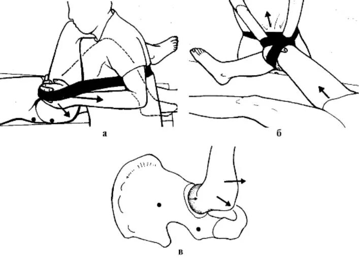 Мобилизация коленного сустава. Сгибательно отводящая контрактура тазобедренного сустава. Сгибательная контрактура коленного сустава. Ротация коленного сустава схема. Вытяжение тазобедренного сустава.