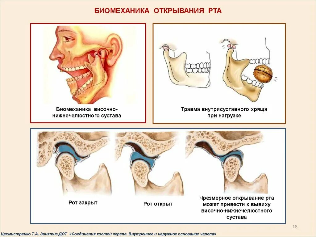 Внчс уха. Подвывих височно-нижнечелюстного сустава. Вправление вывиха височно-нижнечелюстного сустава. Вывих нижнечелюстного сустава.