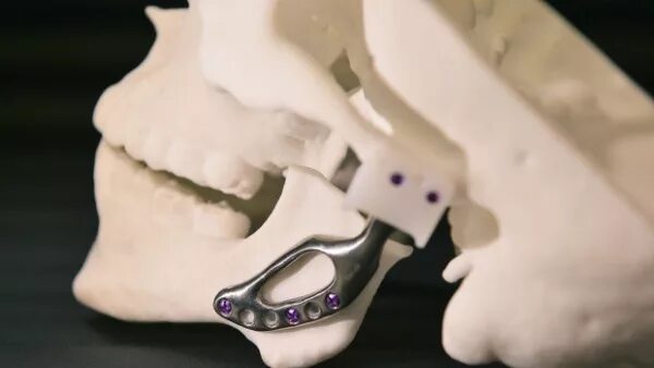 Титановое протезирование. Бюгельный протез титан. Зубные протезы 3д принтер peek. Титановое протезирование. Титановый протез коленного сустава.