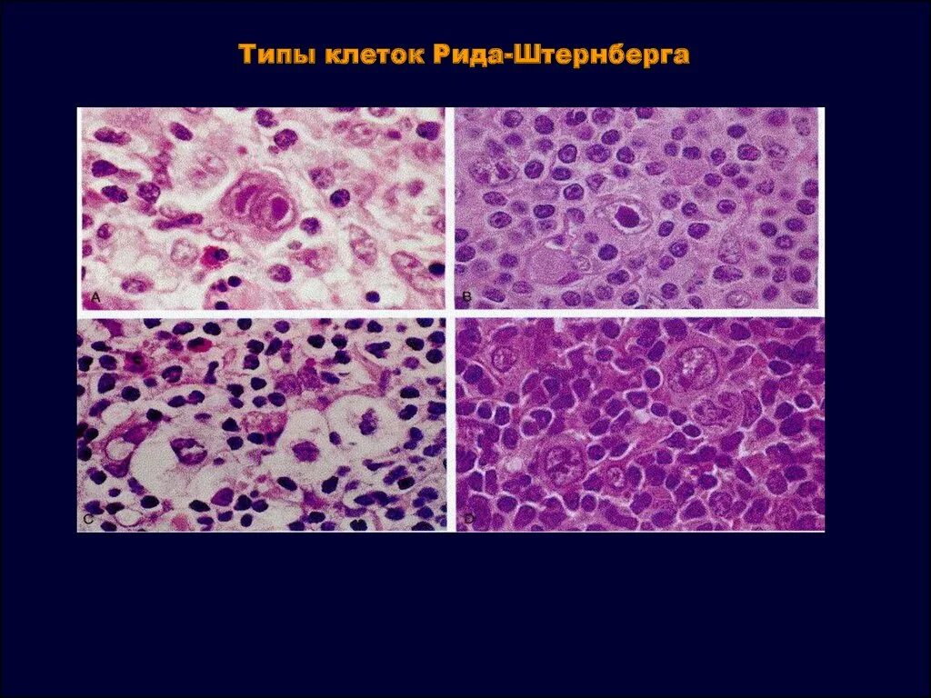 Лимфома ходжкина клетки березовского-штернберга-рид. Клетки рид-березовского-штернберга. Клетки рида березовского штернберга. Рид штернберга клетки гистология. Клетки рида березовского штернберга.