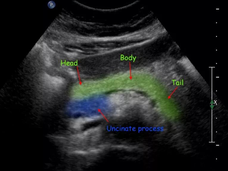 Сонограмма поджелудочной железы. Поджелудочная железа УЗИ при патологии. УЗИ брюшной полости поджелудочная железа. Нормальная поджелудочная железа на УЗИ. На узи видно поджелудочную железу