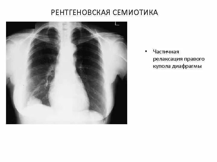 Релаксация купола диафрагмы что это такое. Рклаксация куполов диаафрагмы. Релаксация купола диафрагмы. Частичная релаксация диафрагмы рентген. Релекцасия правой Купала Диафрогма.