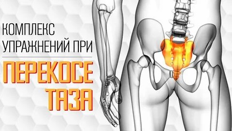 Перекос таза боль в пояснице коксартроз