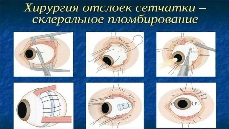 Отслойка сетчатки глаза операция после операции. Экстрасклеральное баллонирование сетчатки глаза. операция при отслойке сетчатки. баллонирование склеры.