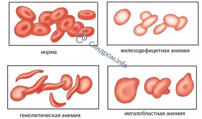 Пациент с железодефицитной анемией. Пациент с железодефицитной анемией
