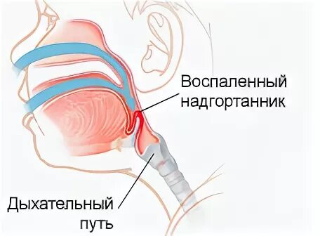 Эпиглоттит симптомы. Гемофильная инфекция эпиглоттит. Воспаленный надгортанник.