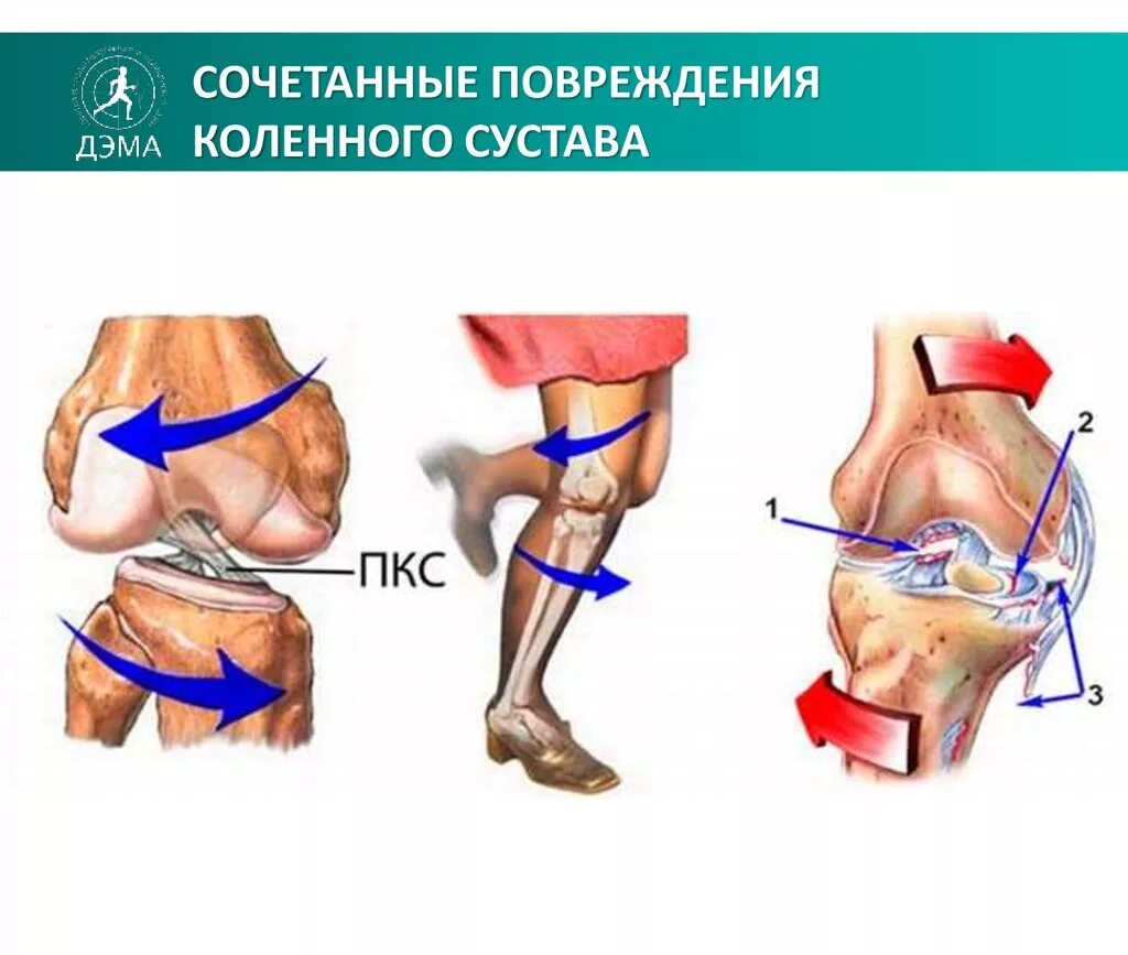 Разрыв связок ПКС коленного сустава. Механизм травмы передней крестообразной связки коленного сустава. ПКС (передняя крестообразная связка). Повреждения передней крестообразной связки (ПКС).