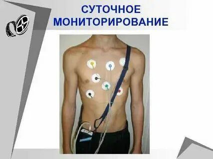Холтер схема расположения датчиков Холтеровское мониторирование схема расположения датчиков