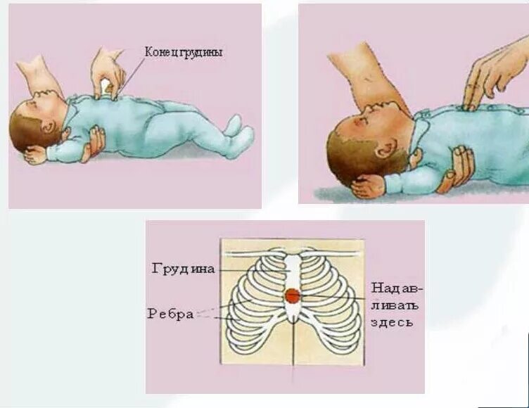 Искусственное дыхание новорожденному