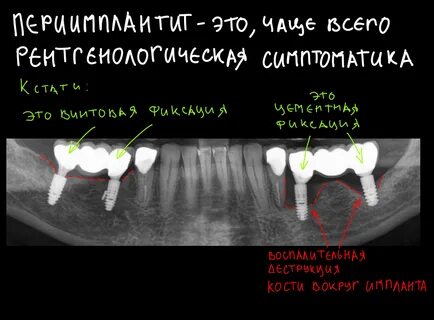 Воспались импланты
