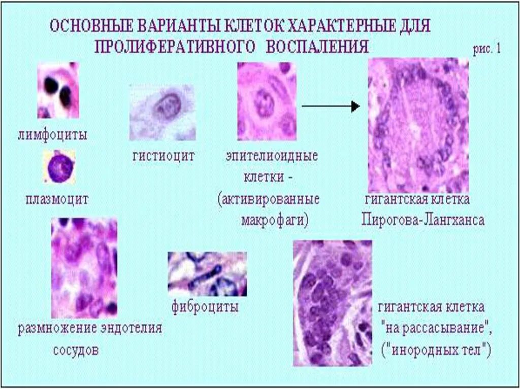 Воспаление с реактивными изменениями клеток. Клетки Пирогова Лангханса гистология. Многоядерные клетки Пирогова-Лангханса.