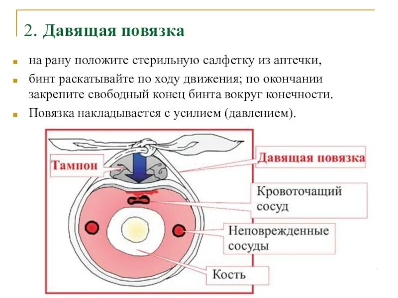 Остановка кровотечения методом тампонирования. Тампонада кровотечения в ране. Остановка кровотечения методом тампонады раны.