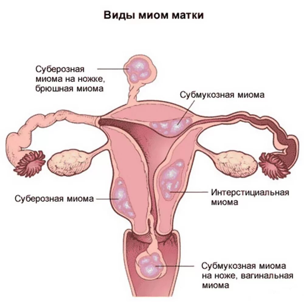 Миома матки симптомы и признаки. Интралигаментарная миома. Миоматозный узел матки.