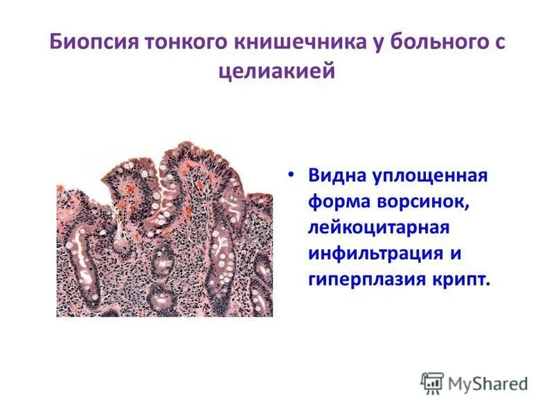 Гиперплазией крипт. Псевдоэпителиоматозная гиперплазия гистология. Гиперплазия эндометрия гистология. Гиперпластический полип желудка микропрепарат. Грануляционный полип гистология.