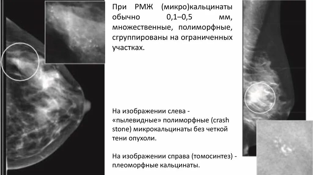 Округлые кальцинаты. Кальцинаты на маммографии. Протоковые кальцинаты. Множественные кальцинаты на маммографии. Полиморфные кальцинаты в молочной железе.