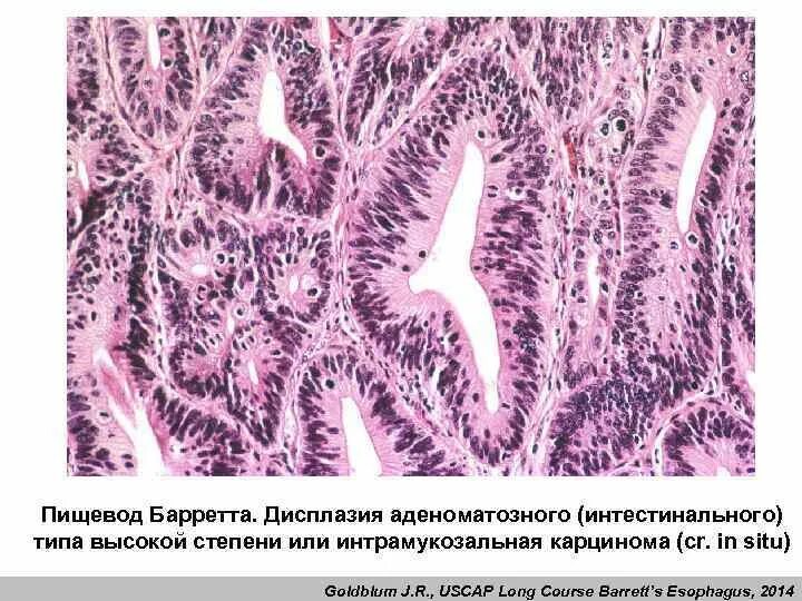 Пищевод баретта. Пищевод Барретта гистология. Пищевод Барретта препарат. Морфологическая картина пищевода Барретта что это. Гистология при пищеводе Барретта.