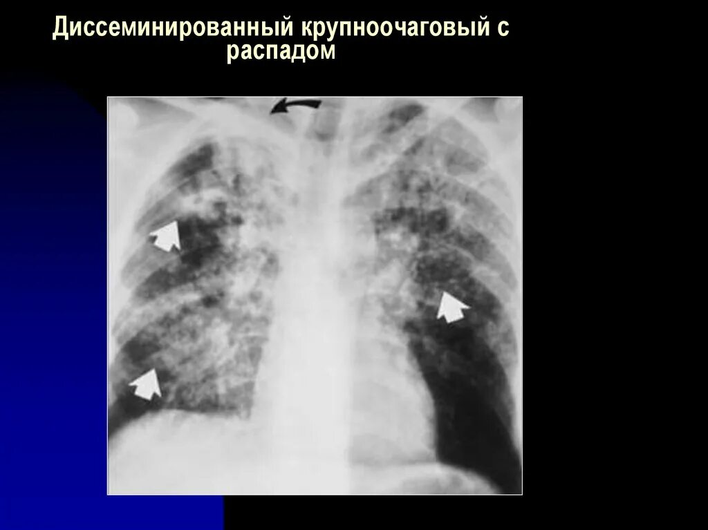 Диссеминированный туберкулез фаза инфильтрации