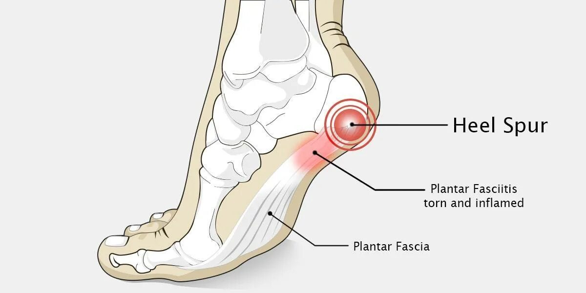 Плантарный фасциит стопы. Пяточная шпора плантарный фасциит. Пяточно подошвенный фасциит. Фасцит в пятке