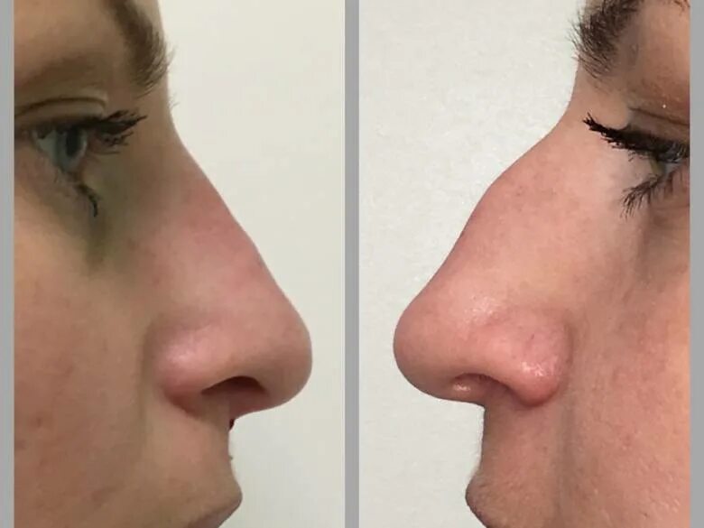 Пластика кончика носа. Исправление горбинки носа филлерами. Аугментационная ринопластика. Аугментационная ринопластика носа. Безоперационная ринопластика.