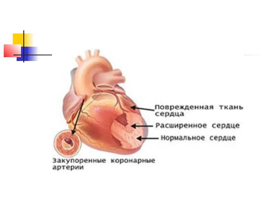 Здоровое и больное сердце. Влияние курения на сердце. Расширение сердечного сосуда