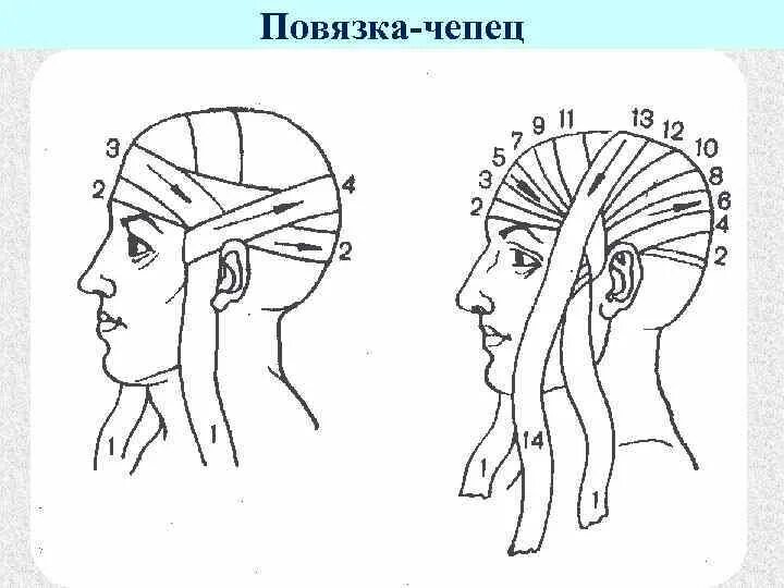 Схема наложения повязки чепец. Перевязка чепец техника. Наложение повязки чепец алгоритм. Бинтование головы чепец.