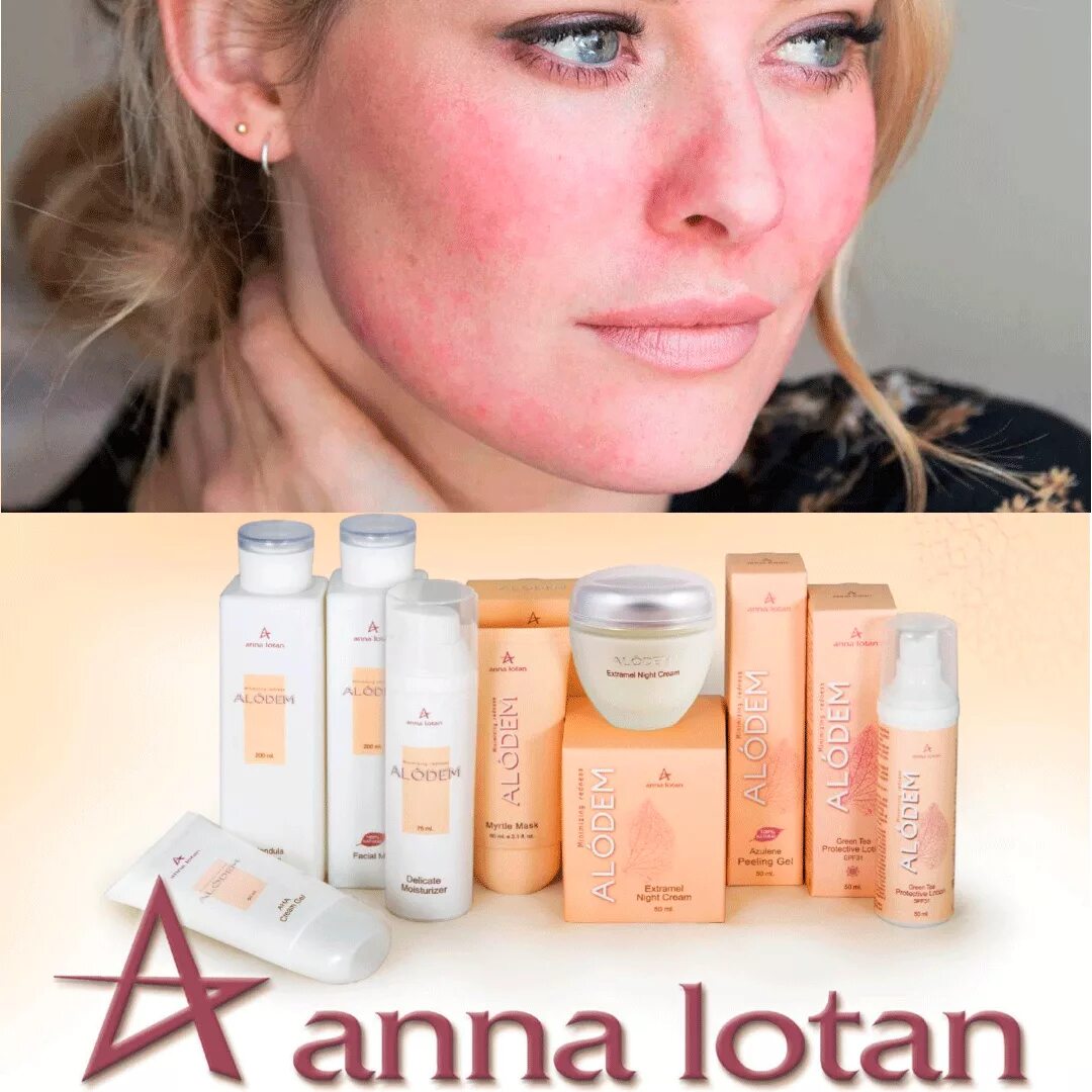 Аллергия на карбоновый пилинг. Химический пилинг гликолевой кислотой. Можно пилинг при куперозе. Пилинг джесснера для лица в косметологии. Химический пилинг до и после.