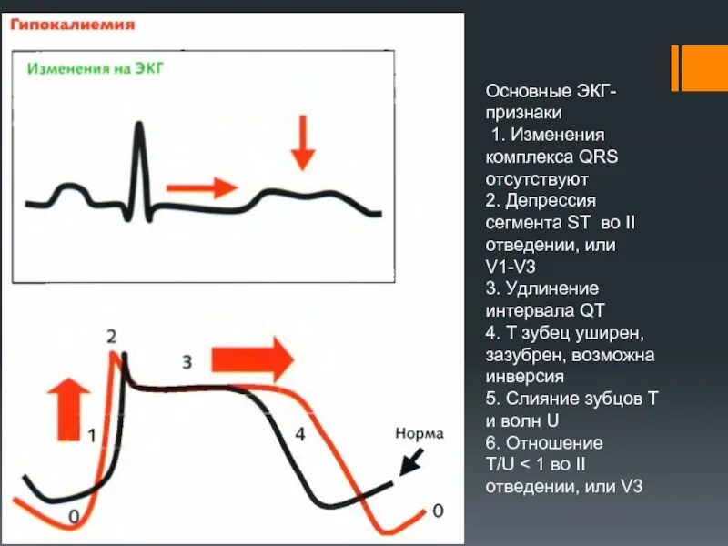 Зубец в сегменте st. Сегмент st на экг депрессия в v1v2v3. экг 2 отведение зубец qrs зазубрен. расширение qrs на экг. изменения комплекса qrs на экг.