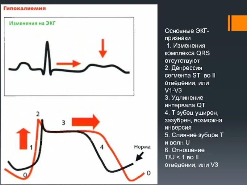 Депрессия сегмента st. Сегмент St на ЭКГ депрессия в v1v2v3. ЭКГ 2 отведение зубец QRS зазубрен. Расширение QRS на ЭКГ. Изменения комплекса QRS на ЭКГ.