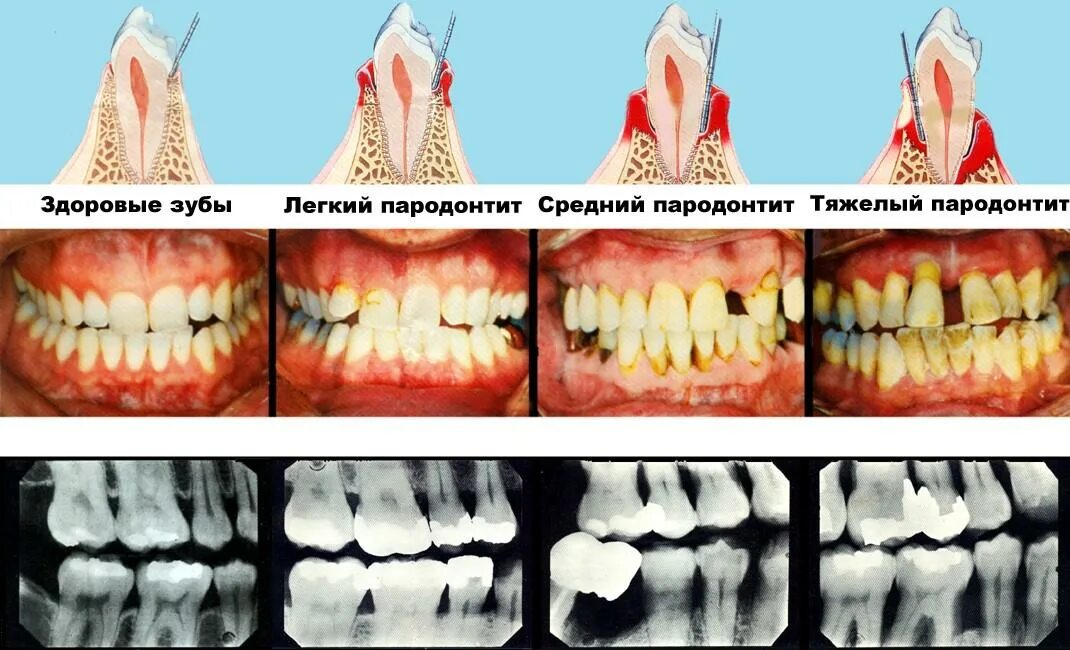 Язвенно некротический гингивит. Воспаление десен пародонтит.