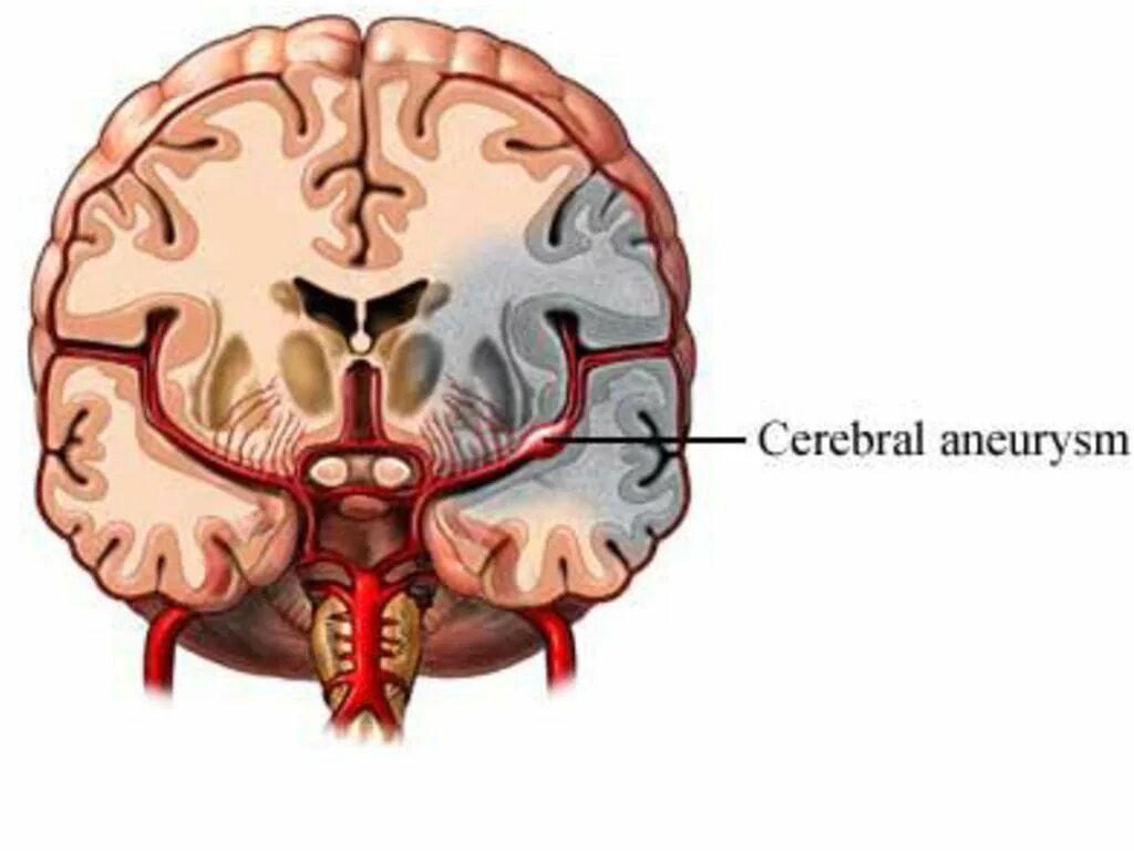 Церебральная аневризма. Аневризма головного мозга. Аневризмы сосудов головного мозга. Разрыв аневризмы головного мозга. Аневризма мозга простыми словами