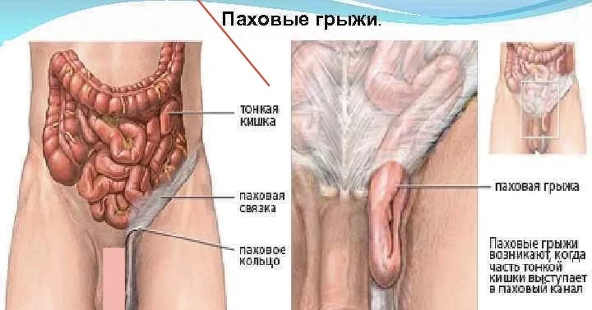 Паховая грыжа что можно кушать. Паховомашоночная грыжа. вправимая паховая грыжа.