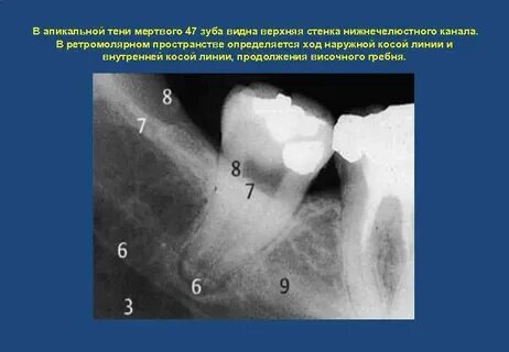 Апикальный упор