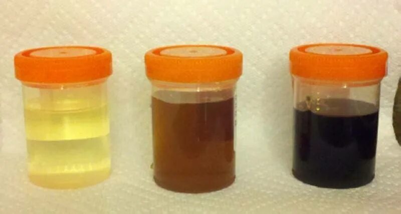 8 Different Urine Colours And What They Say About Your Health(photos) Nairalan