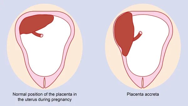 Предлежание плаценты с врастанием. Степени приращения плаценты. Плацента на рубце матки
