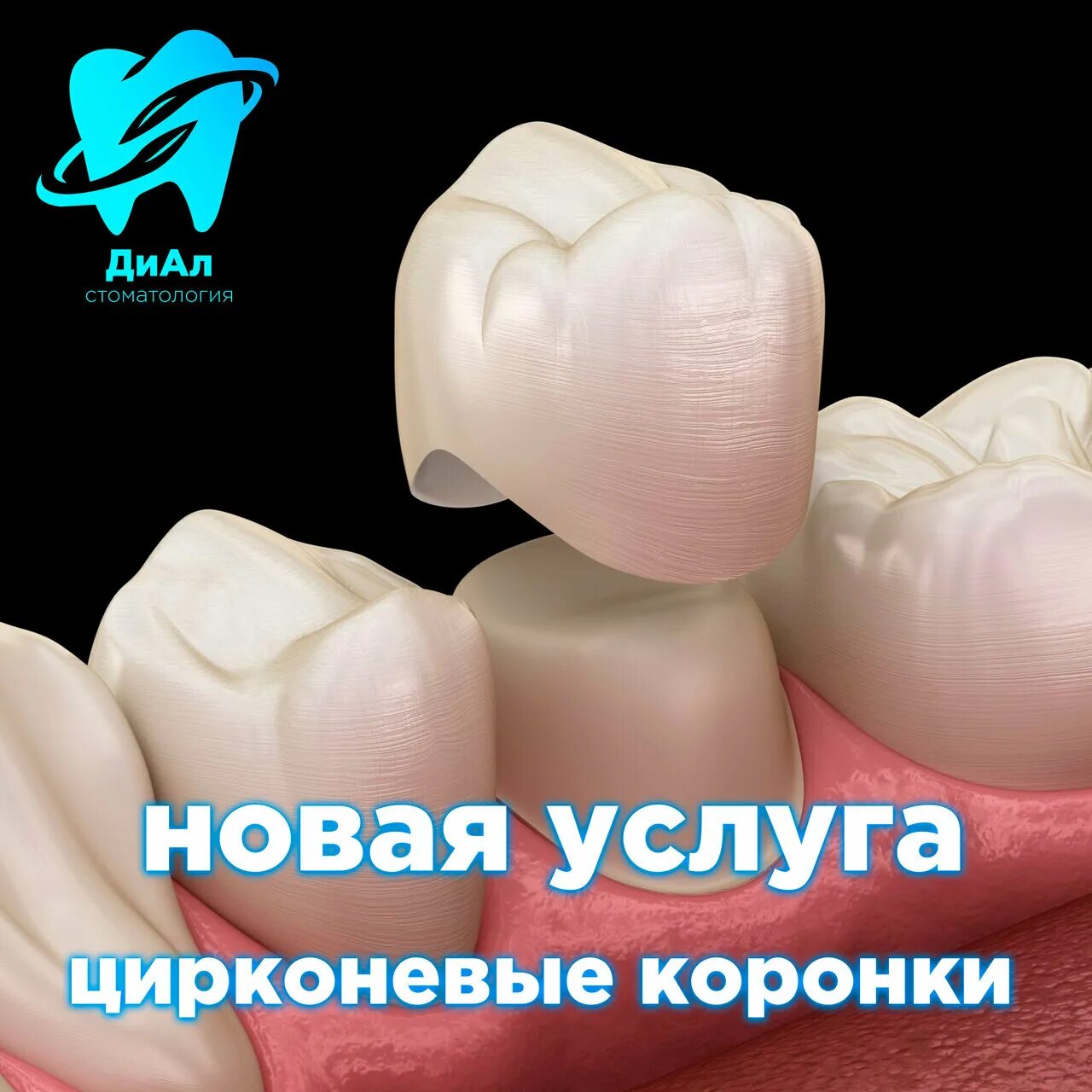 Стальная штампованная коронка. Коронка щелкает. Бюгельный протез с телескопической системой фиксации. Мостовидный протез из e max. Мостовидный протез металлокерамика.