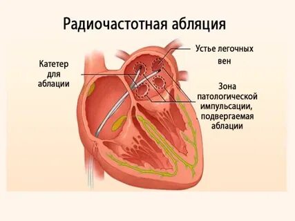 Мерцательная аритмия абляция отзывы